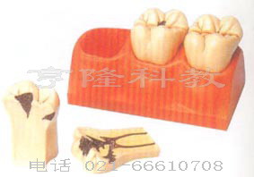 解剖醫(yī)學(xué)模型|齲齒分解模型