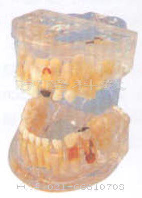 醫(yī)學(xué)解剖模型|透明乳牙病理模型