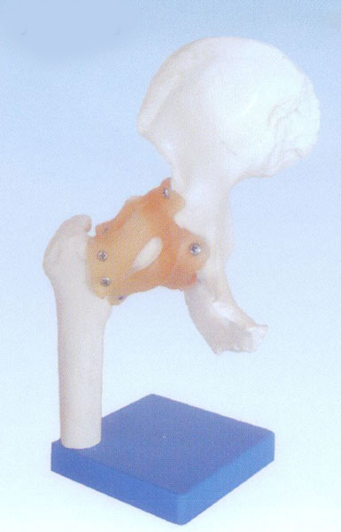 自然大髖關節(jié)模型